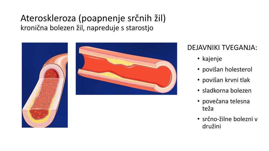 Ateroskleroza (poapnenje srčnih žil) kronična bolezen žil, napreduje s starostjo