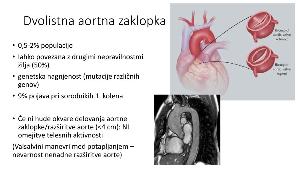 Dvolistna aortna zaklopka