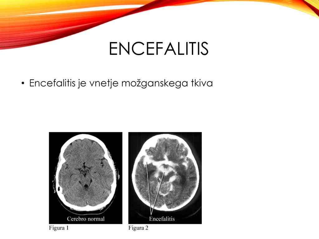 ENCEFALITIS Encefalitis je vnetje možganskega tkiva